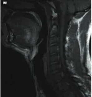 Figure 3 - Axial CT slice at the oropharyngeal level  showing the pathological pattern of the air passage  anteroposteriorly.