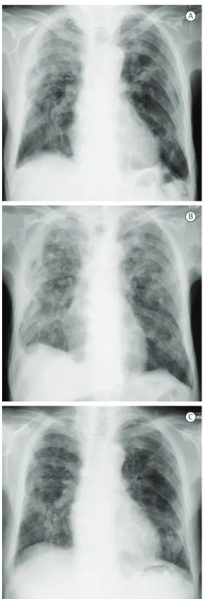 Figure 1 - Chest X-rays showing multiple ground-glass  attenuation at admission (in A); just after the family’s  visit (in B), when the symptoms all worsened; and  two months after the treatment with glucocorticoids  and sulfamethoxazole-trimethoprim (in C