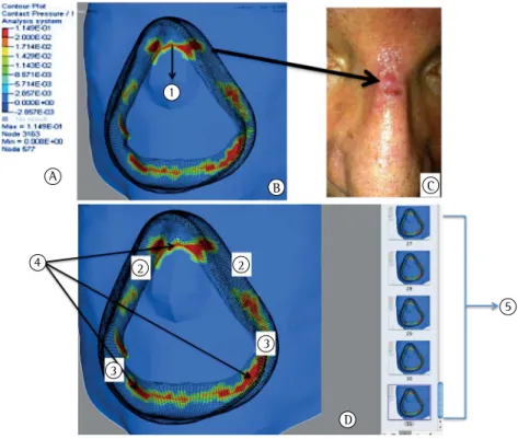 Figure 3 - Graphical images of pressure zones (A), in which blue, green, yellow, and red, respectively,  indicate ascending values for pressure and contact pressure; pressure zones (B) of an oronasal interface and  a corresponding skin lesion (C) induced b