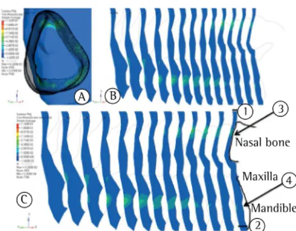 Figure 4 - A: Von Mises equivalent stress distribution  (a combination of all stress components) on the skin  surface; B: pressure variation according to soft tissue  depth.