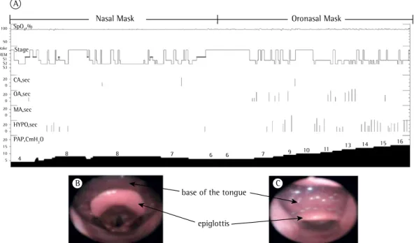 Figure 4 - In A, polysomnography summary of a continuous positive airway pressure (CPAP) titration study  during natural sleep