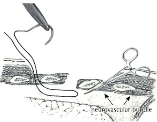Figure 1 - Preparation for thoracotomy closure. Blunt  dissection is performed in the virtual space between  the lower rib and the neurovascular bundle so that  the suture material can pass through the chest wall  without compressing the intercostal nerve 