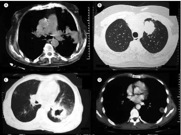 Figure 1 - Helical CT scans showing an irregular lung mass (in A; male patient, 77 years old), a bosselated  lung mass (in B; male patient, 30 years old), a spiculated lung mass (in C; male patient, 64 years old), and  a regular lung mass (in D; male patie