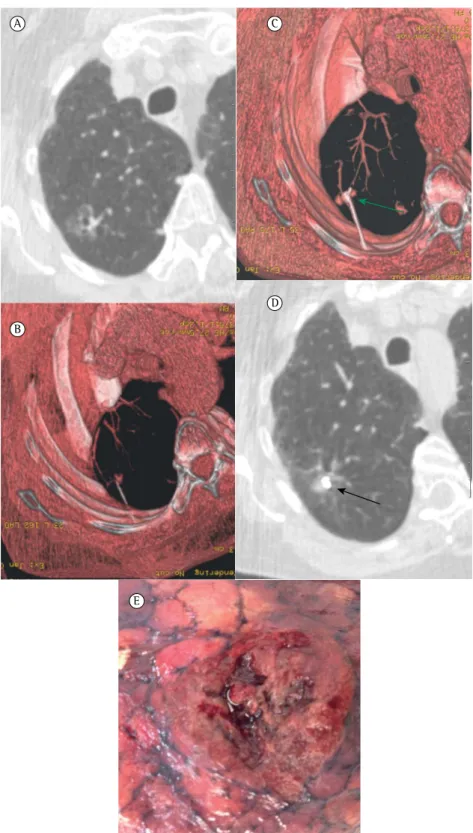 Figure 1 - In A, a CT scan demonstrating a 1-cm ground-glass nodule in the central portion of the  right upper lobe