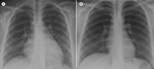 Figure 2 - In A, a chest X-ray taken at admission showing a mixed interstitial pattern (reticular and  micronodular) and cardiomegaly