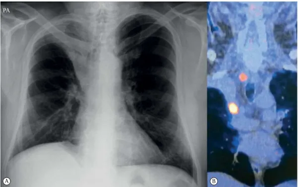 Figure 2 - In A, photograph of the resected right  upper lobe and mediastinal lesion. In B, photograph  of the mediastinal lesion.