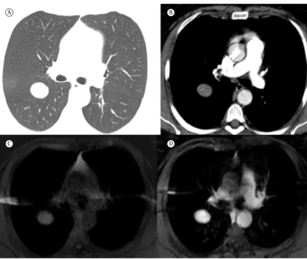 Figure 1 - CT scans and magnetic resonance imaging of the chest. In A and B, chest CT scans (lung window,  in A, and mediastinal window, in B) showing an oval nodule with homogeneous density, well-defined  margins, and contrast enhancement