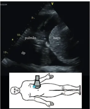 Figura 1 - Identificação ultrassonográfica de derrame  pleural em local específico (imagem menor)