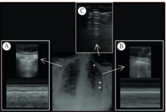 Figura 4 - Sinais ultrassonográficos de pneumotórax. 
