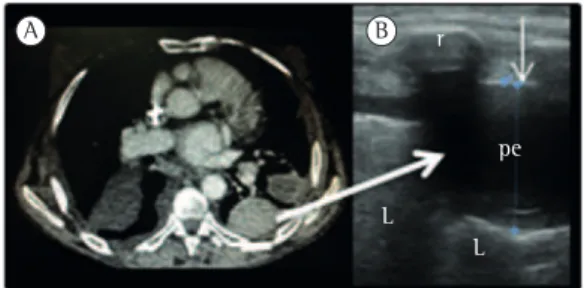 Figure 3 - X-ray (in A) and ultrasound (in B) revealing  pleural effusion and lung collapse