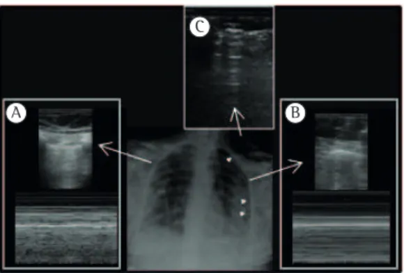 Figure 4 - Ultrasound signs of pneumothorax. In A,  normal lung, showing the seashore sign in M mode