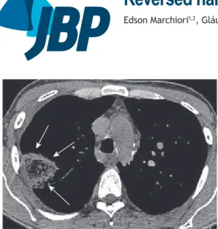 Figure 1. CT scan (mediastinal window settings) showing  the reversed halo sign in the right lung (white arrows)
