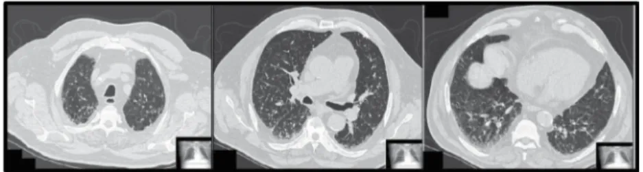 Figura 1. TC de tórax mostrando micronódulos distribuídos aleatoriamente nos pulmões, além de linfonodomegalia hilar e  mediastinal.