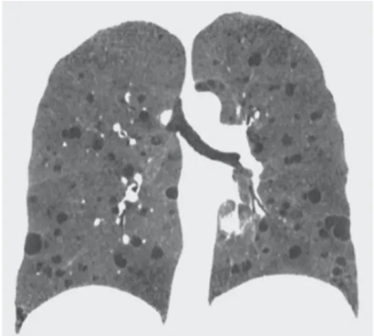 Figure 1. HRCT scan showing multiple, round, thin-walled  cysts distributed homogeneously throughout the lungs