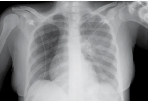 Figura 3. Reconstrução coronal demonstrando a completa  falta de perfusão pulmonar no pulmão direito associada a  oligoemia ipsilateral.