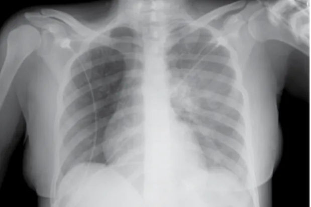 Figure 3. Coronal reconstruction demonstrating the complete  lack of pulmonary perfusion in the right lung, together with  ipsilateral oligemia