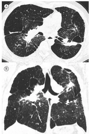 Figure 3 - Talcosis. A 35-year-old male injection  cocaine user. The axial (in A) and sagittal (in B) HRCT  scans show bilateral perihilar conglomerate masses,  with irregular margins, associated with architectural  distortion and hyperlucent areas corresp