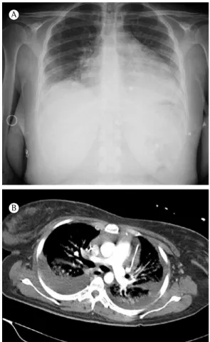 Figure 3 - In A, chest X-ray showing enlarged cardiac  silhouette and bilateral pulmonary opacities; in B, chest  CT scan showing bilateral pleural effusion, abundant  pericardial effusion, and bilateral alveolar opacities.