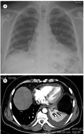 Figure 4 - In A, chest X-ray showing bilateral pleural  opacities and enlargement of the cardiac silhouette; 