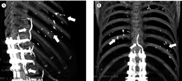 Figure 1 - Axial CT image. White arrows indicate  embolized polymethylmethacrylate in the azygos  system and pulmonary arteries.