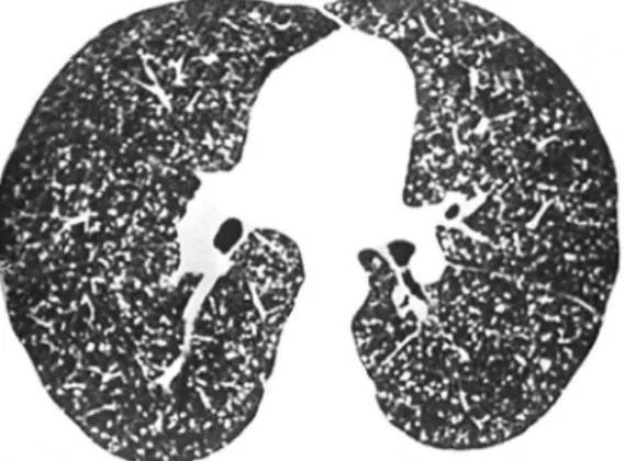 Figura 1 - Pequenos nódulos distribuídos  homogeneamente pelos pulmões, sem predominar  em nenhum compartimento específico