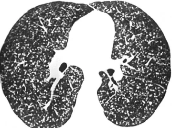 Figure 1 - Small nodules evenly distributed throughout  the lungs, no particular lung compartment being  predominantly affected