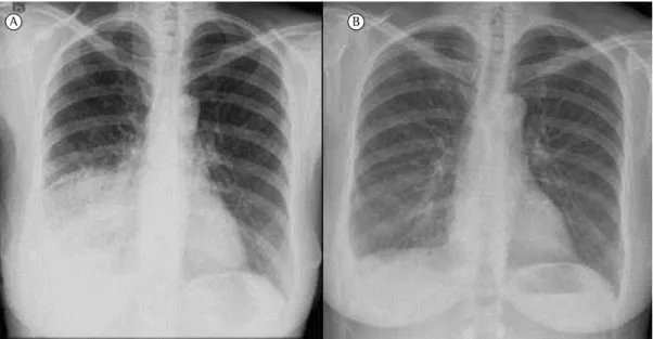 Table 1 - Pulmonary function test results before and after treatment with sirolimus. a