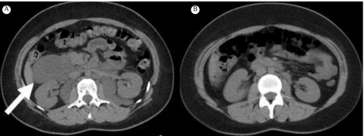 Figure 2 - Abdominal CT scans taken before treatment with sirolimus (in A) and after 12 months of treatment  with the drug (in B), showing a reduction in bilateral renal angiomyolipoma volume