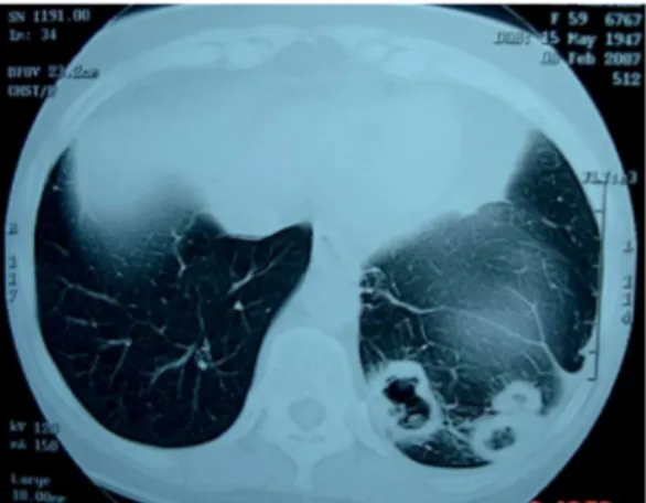 Figure 2 - CT scan of the chest showing a nodular  opacity adjacent to the pleural surface, located in  the right lower lobe.
