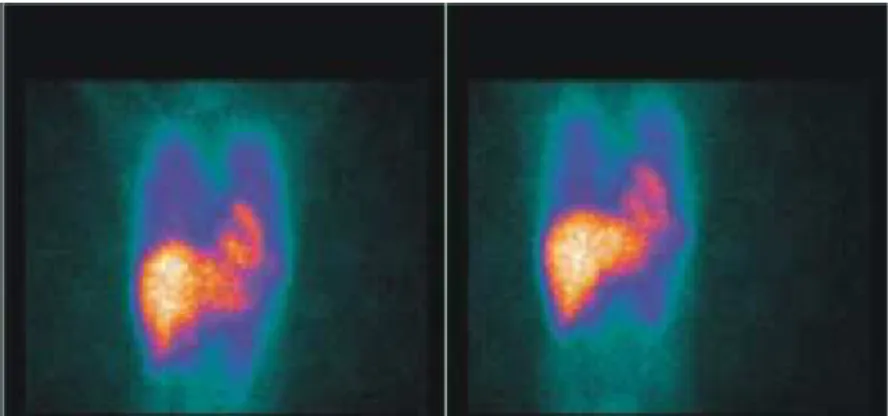 FIGURA 6 - Padrão cintilográfico de inervação cardíaca com washout cardíaco da  123 I-