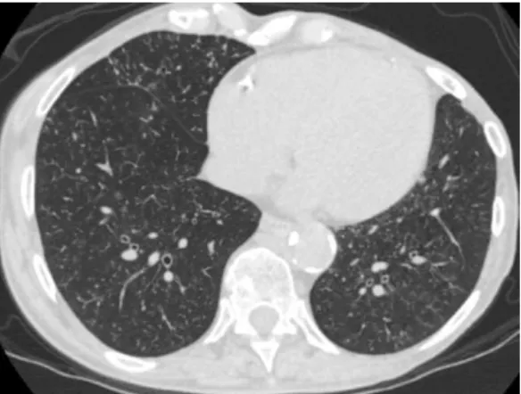 Figure 1 - HRCT scan of the chest, showing diffuse  micronodules and tree-in-bud opacities
