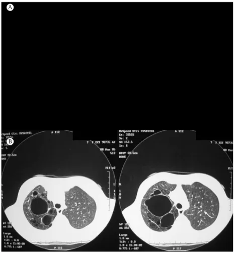 Figura 2 - Radiografia e TC de tórax de um paciente com diagnóstico pré-natal de  doença cística pulmonar