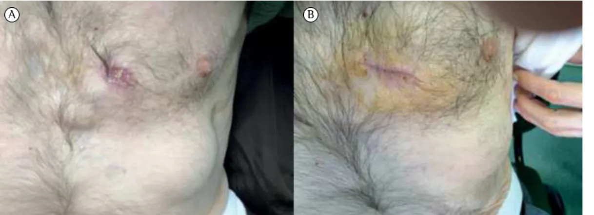 Figura 1 - Antes e depois do tratamento (à esquerda e à direita, respectivamente). 