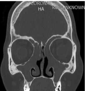 Figure 3 - Widespread nasal polyposis and frontal  sinus hypoplasia in an adult cystic fibrosis patient who  had undergone nasal surgery and had no sinonasal  symptoms