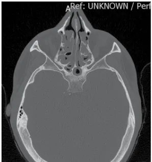 Figure 5 - Axial CT scan of the sinuses showing  sphenoid sinus hypoplasia in a 25-year-old patient  with cystic fibrosis