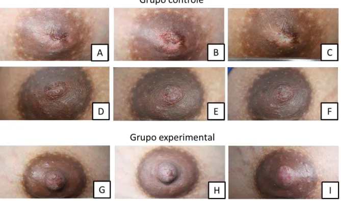 FIGURA 4.4-  Imagem comparativa das lesões mamilares ao longo de 3 sessões. 