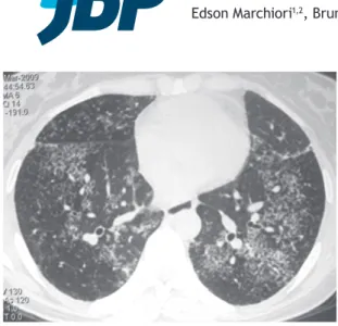 Figure 1. HRCT scan showing clusters of small nodules with  no conluence in the lower lobes of both lungs.