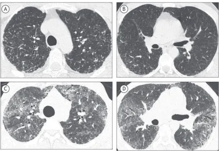 Figure 2. HRCT scans. Case 3 (Figures A and B): micronodular opacities distributed in a perilymphatic pattern,  predominantly  in  the  middle  and  upper  lung  ields