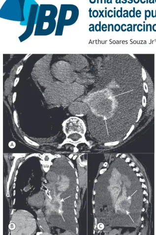 Figura 1. Imagens de TC de tórax nos planos axial (em A),  coronal (em B) e sagital (em C) mostrando derrame pleural à  esquerda e pulmão colapsado, com alta densidade, contendo  uma massa arredondada hipodensa (setas)
