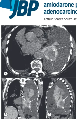 Figure 1. Axial (in A), coronal (in B), and sagittal (in C) chest  CT scans showing left pleural effusion and a high-density  collapsed lung containing a round hypodense mass (arrows)
