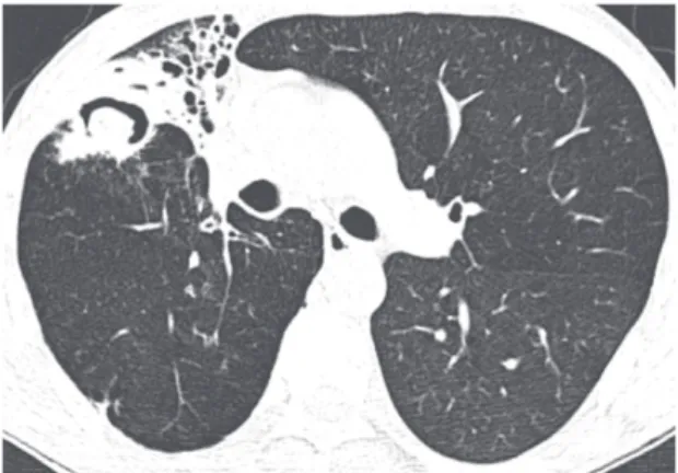 Figure 1. CT scan of the chest with lung window settings  at the level of the main pulmonary artery showing volume  loss in the right upper lobe, as well as bronchiectasis and a  cavitary lesion containing a nodular density