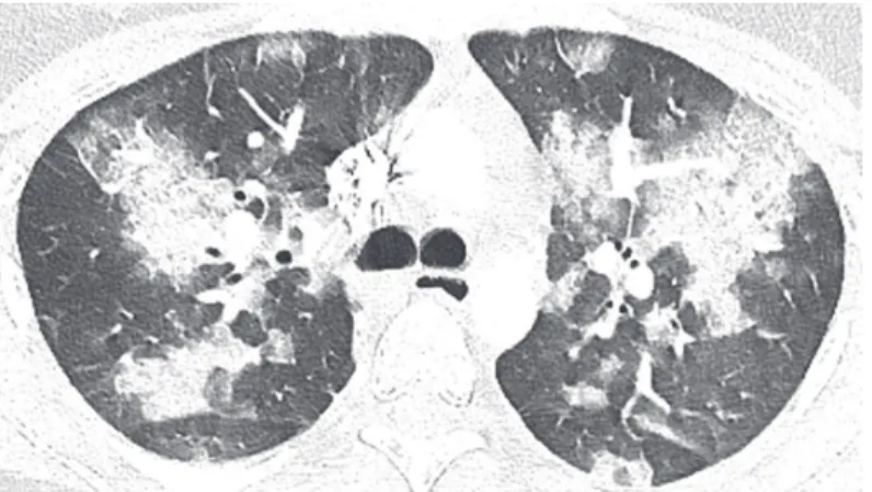 Figure 1. CT of the chest at the level of the main carina showing bilateral consolidations surrounded by ground glass opacities.