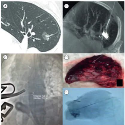 Figure 1. Case 2: In A, a preoperative CT scan. In B, an intraoperative CT scan identifying a nodule in the inlated lung