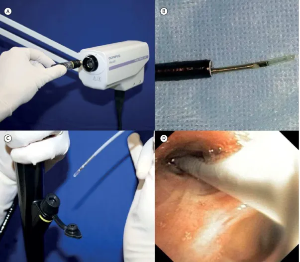 Figure 1. Radial-probe EBUS: (a) probe drive unit; (b) distal end of the radial probe outside the bronchoscope; c)  radial probe being inserted into the working channel of the bronchoscope; and d) bronchoscopic image of the probe  within the segmental bron
