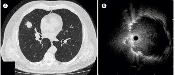 Figure 3. Comparison between CT and radial-probe EBUS: a) CT of the chest, showing a 2.5 cm nodule in the middle  lobe; and (b) radial-probe EBUS image with the probe positioned adjacent to the lesion