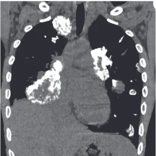 Figure 1. Coronal CT section (mediastinal window settings)  showing multiple partially calciied nodules and masses, of  various sizes, in both lungs.