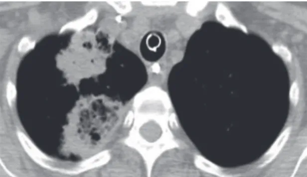 Figure 1. Axial CT image (mediastinal window setting)  showing two right upper lobe masses, one of which has the  characteristics of the reversed halo sign