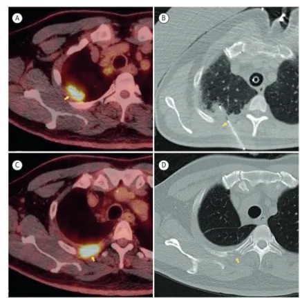 Figure 1. Nodule in the right lung apex and percutaneous biopsy of the same: in A, positron emission tomography-CT  (PET-CT) scan showing the nodule (arrow); in B, CT scan showing the point of insertion of the coaxial needle (arrow); in C,  PET-CT scan aft