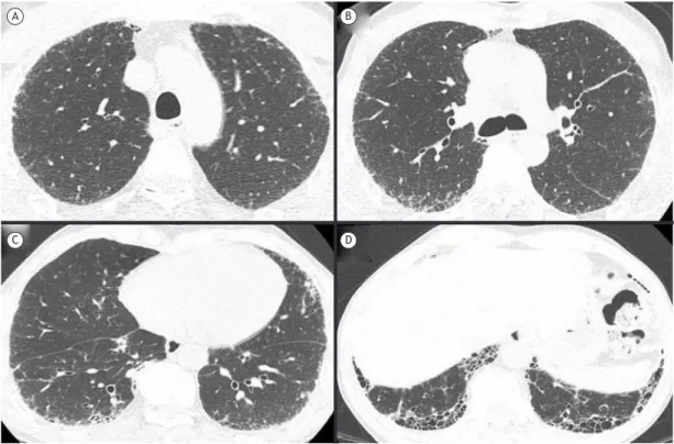 Figure 1. Chest HRCT scans showing indings consistent with the pattern of usual interstitial pneumonia: A) discrete  subpleural reticular opacities in the upper lobes; B) subpleural reticular opacities and discrete areas of ground-glass  abnormalities  at 