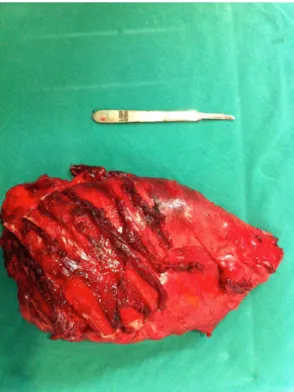 Figure 1. Surgical specimen showing en bloc resection of  the left lung, pleura, and ribs